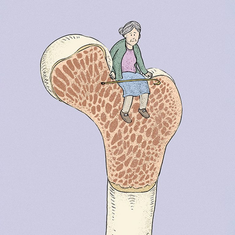 221020-Aca1-des-f1-osteoporosis